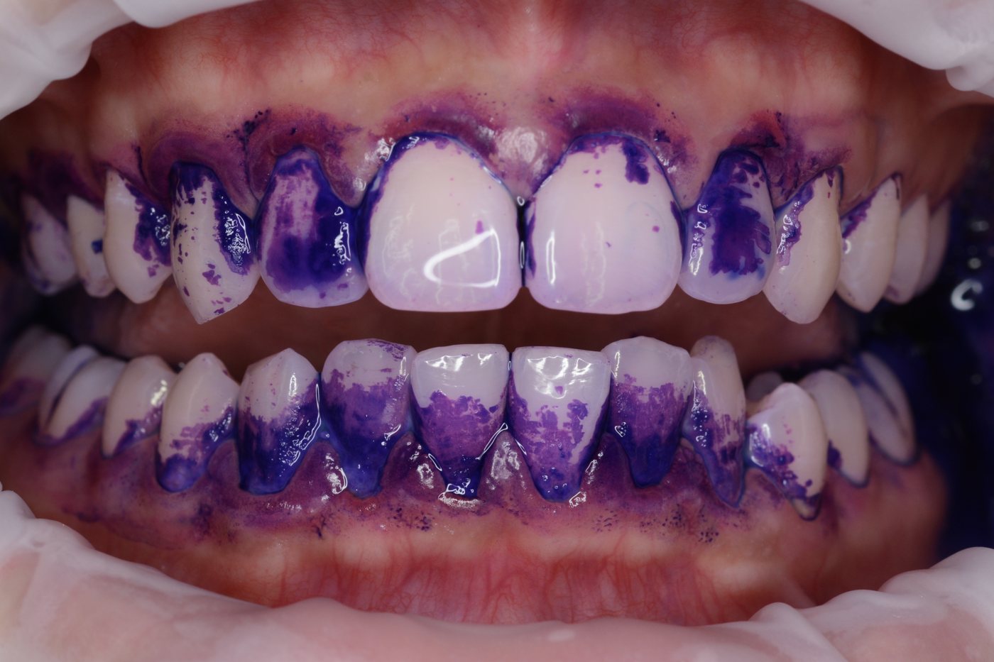 Denti con il rivelatore di biofilm che colora la placca
